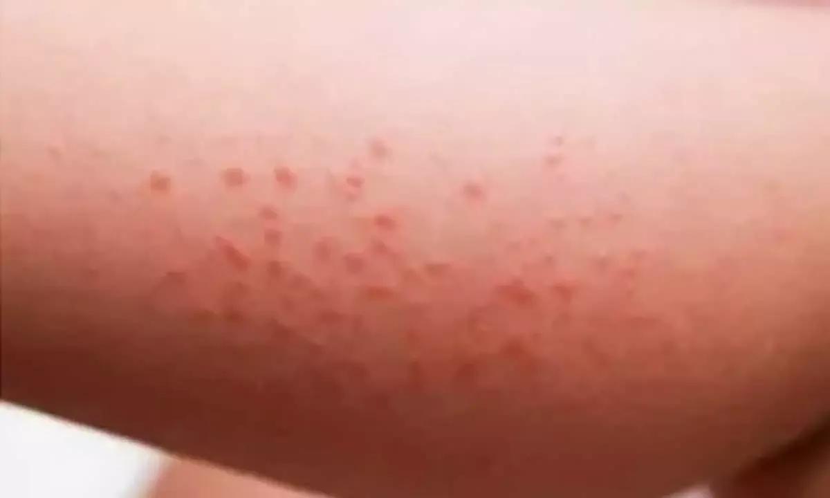 Childhood Allergies Skin