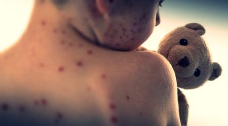 US reports over 2,000 measles cases in 2025, highest since 1992