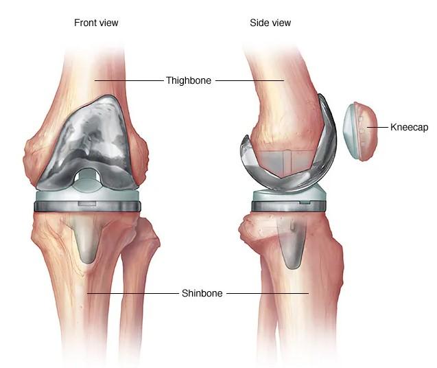 India needs more skilled surgeons for revision knee, hip replacement surgeries, say experts
