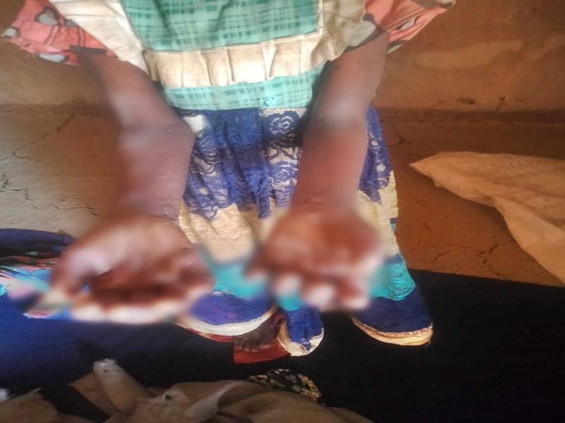 Digvijaya Singh flags skin disease outbreak among children in MP's Betul, seeks urgent action